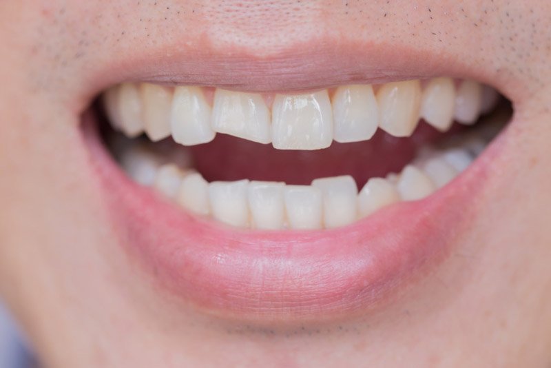 chipped tooth example image