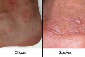 Chigger bites and scabies comparison