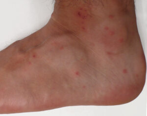 Chigger bites on adult foot