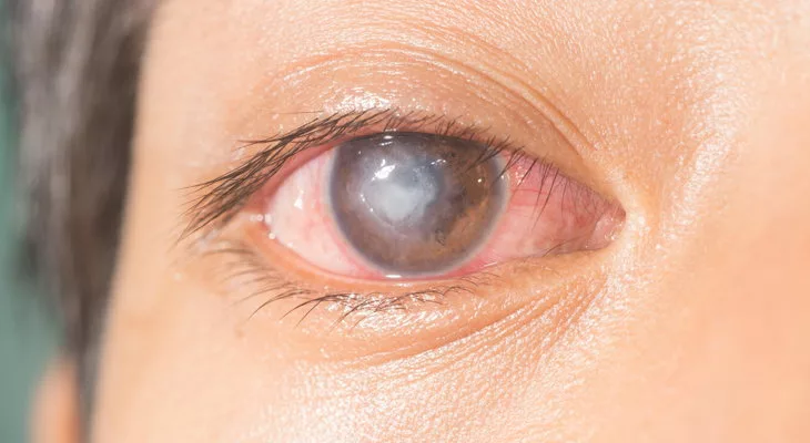 Image of an eye with corneal ulcer