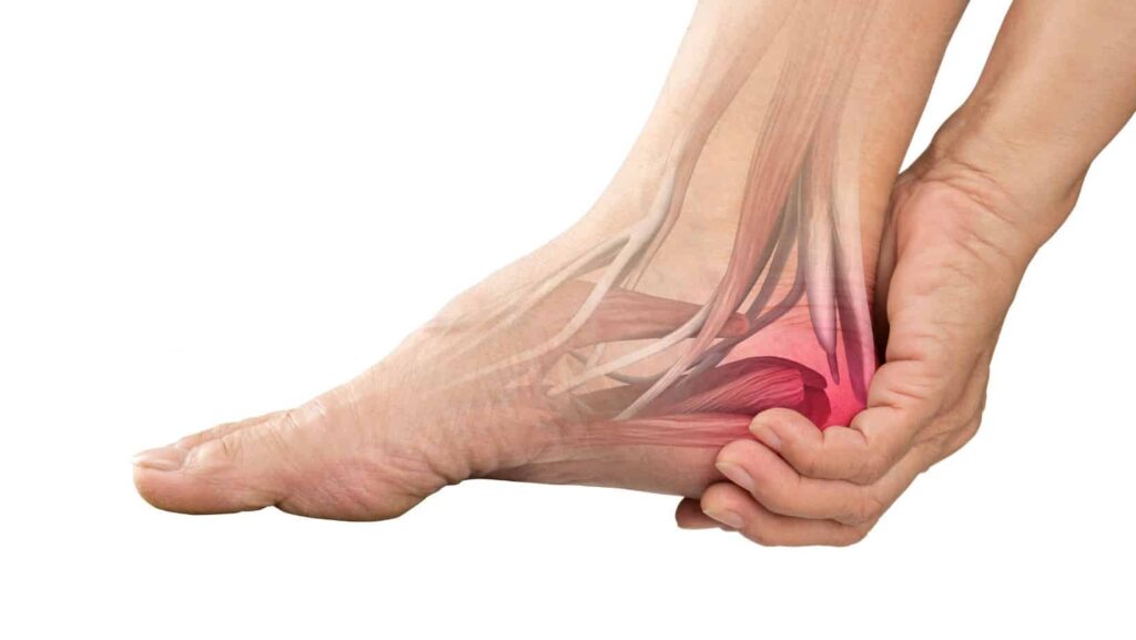 Symptoms of a Bruised Heel