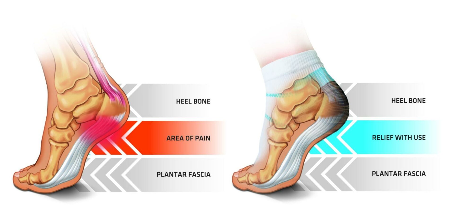 Bruised Heel Pad: Causes, Symptoms, and Treatment - SehatHub