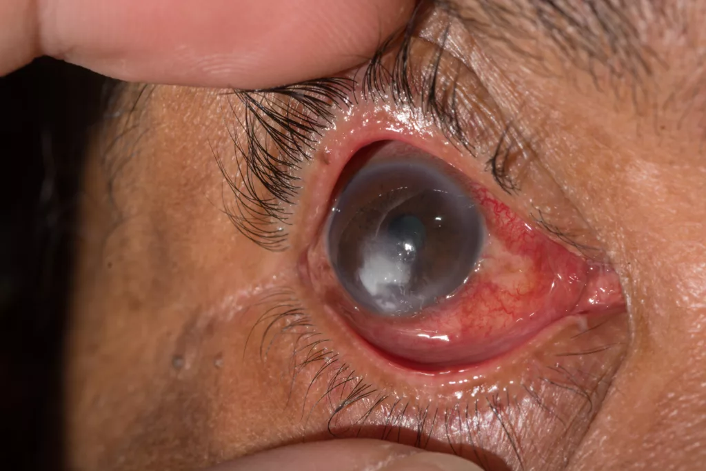 The Image shows ulcer of cornea