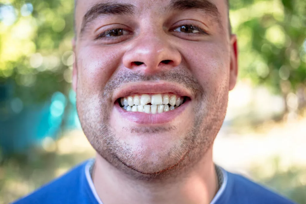 pic of a man with chipped tooth 