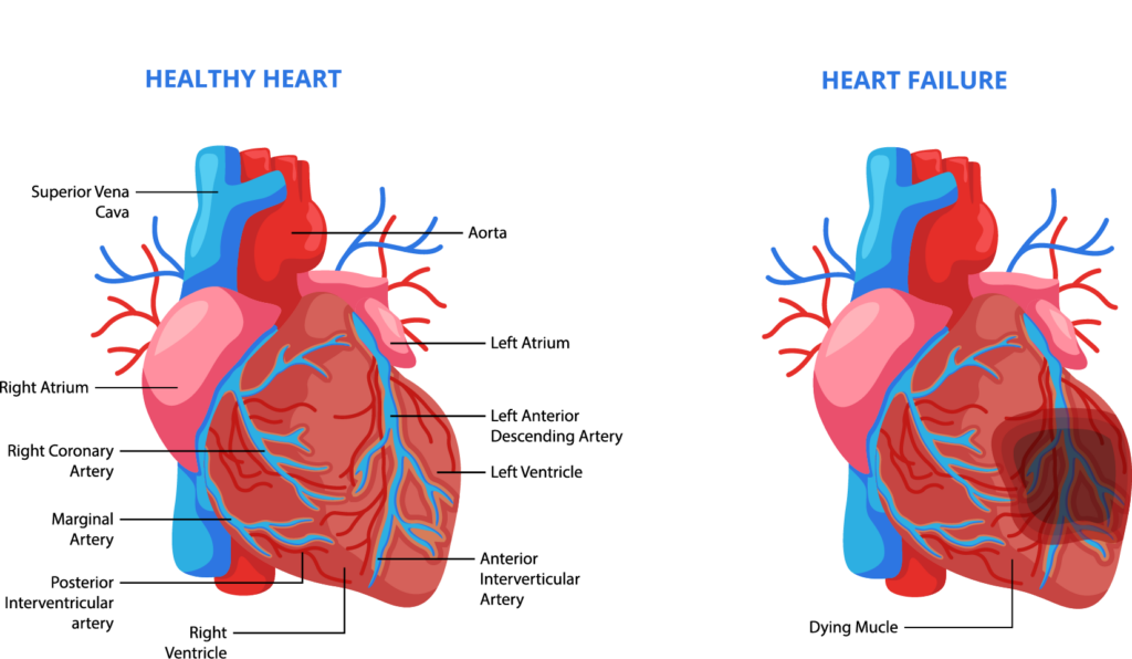 Illustration of Chronic Systolic Heart Failure