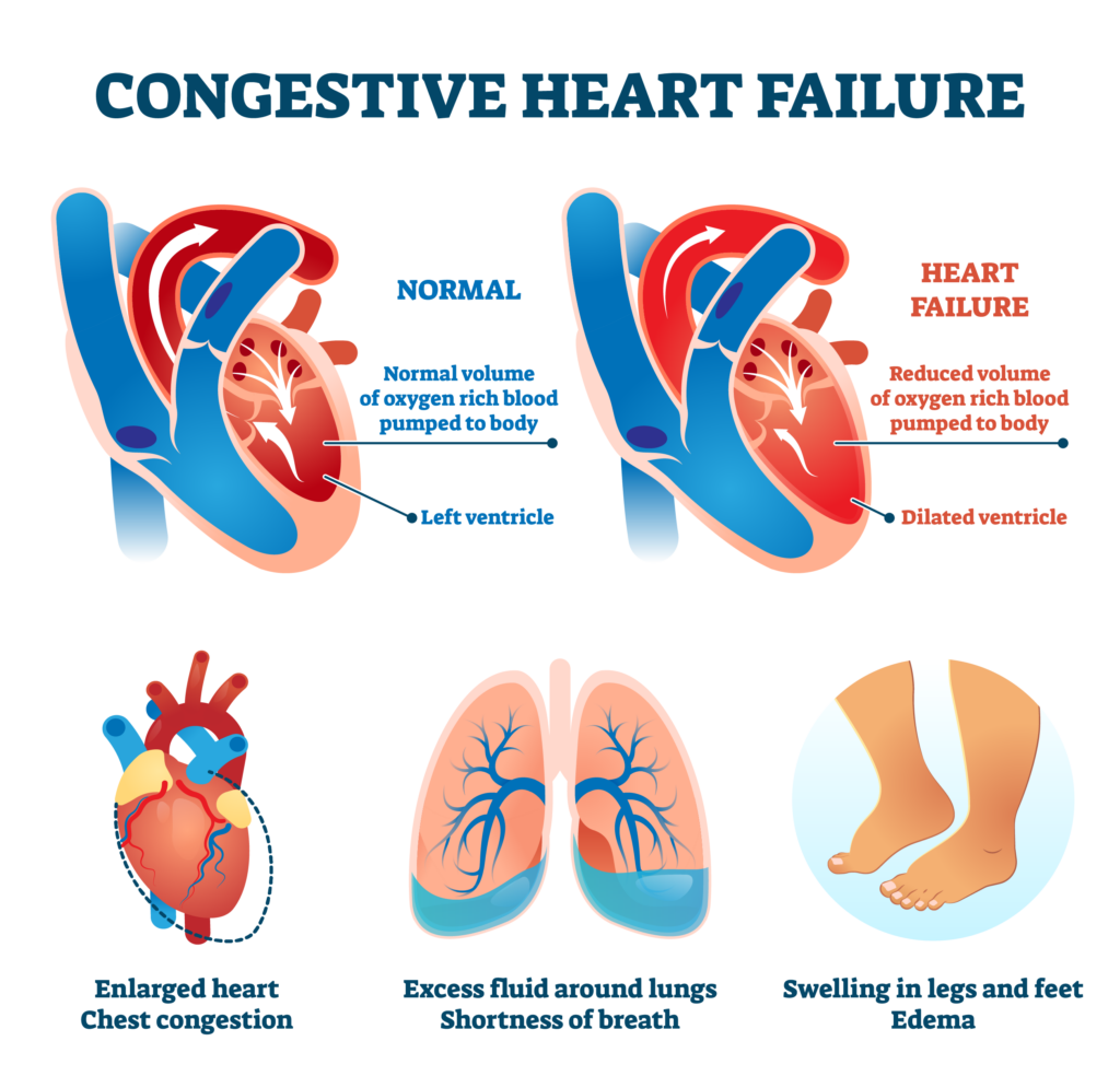 Image depicting the Symptoms of Chronic Systolic Heart Failure
