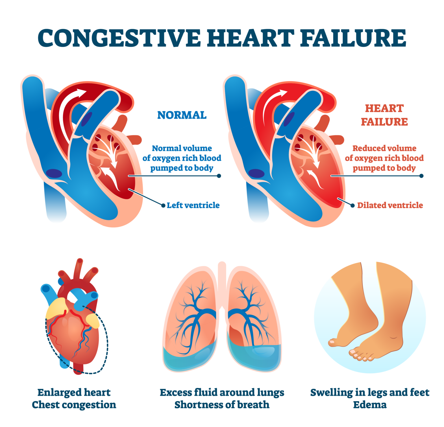 chronic-systolic-heart-failure-an-ailment-of-all-times