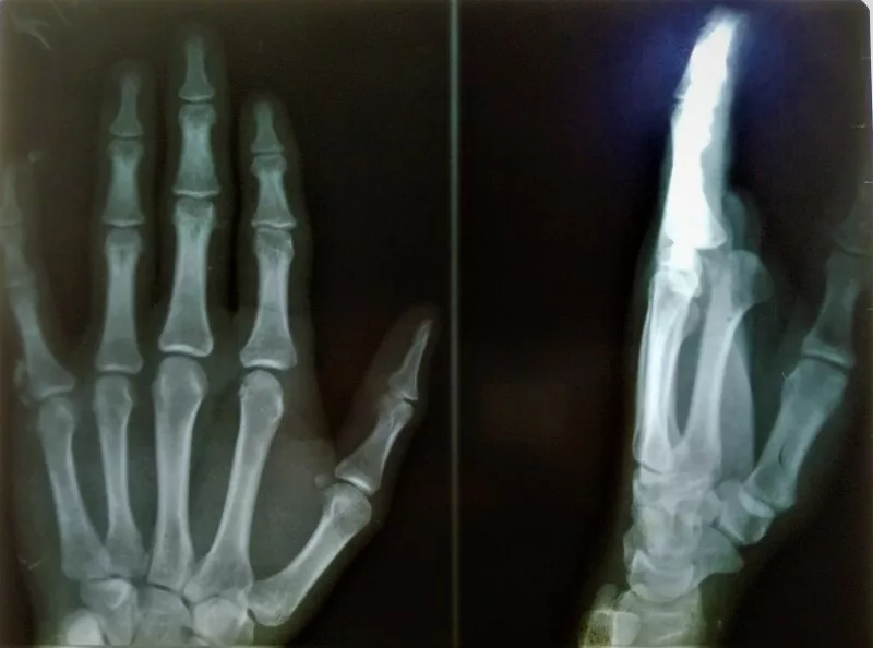 X-ray of a hand with dislocated finger