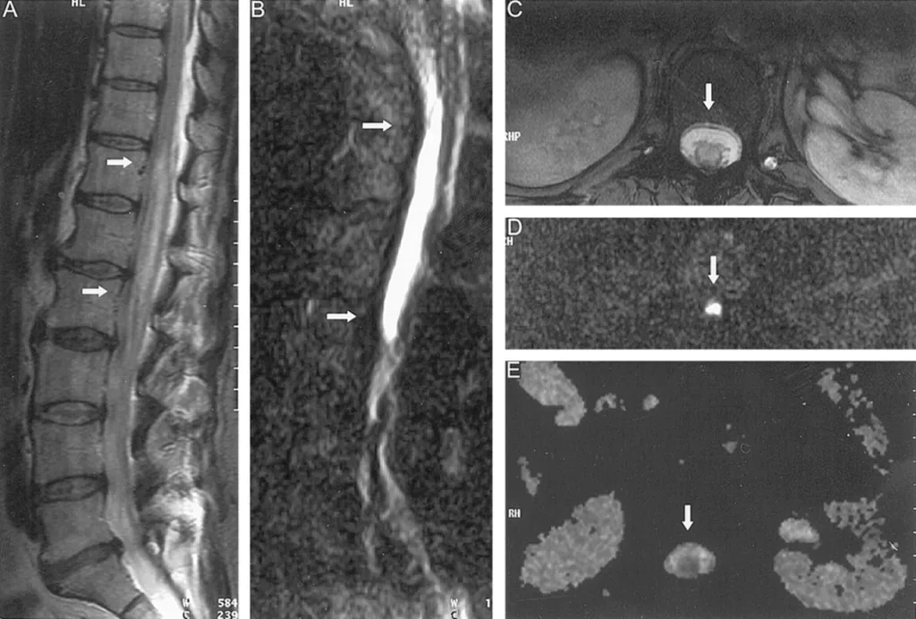 MRI images for Spinal Stroke