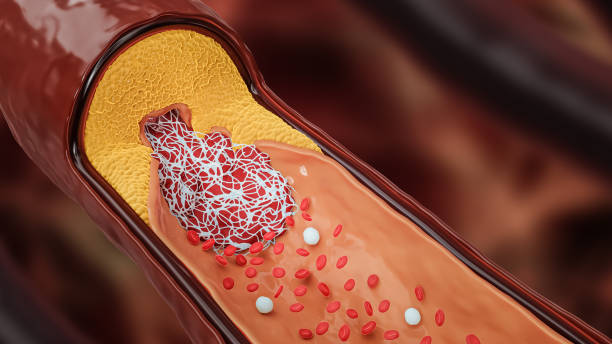 Image showing a blood vessel clogged with cholesterol & fat
