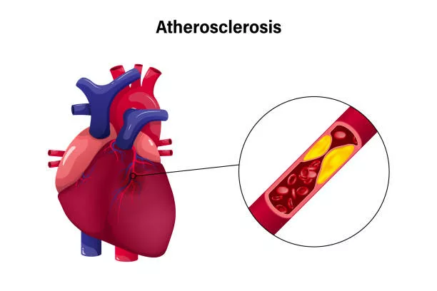 Build up of fats, cholesterol, and other substances in and on the artery walls.