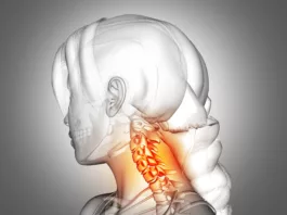 Female 3D model with degenerative cervical spines