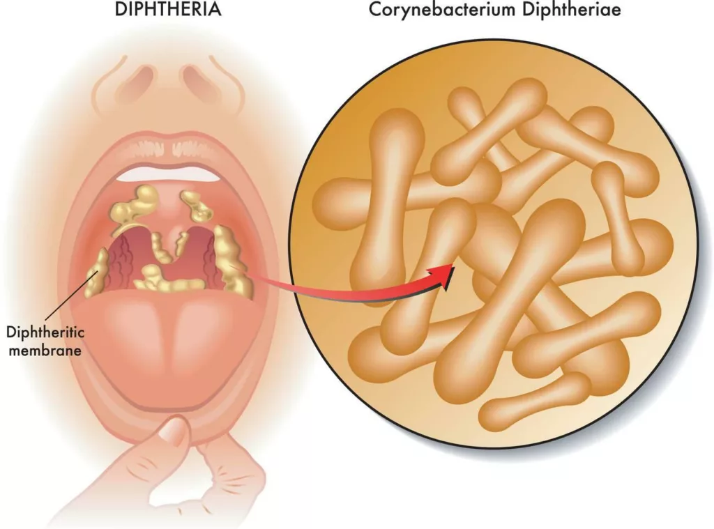 The image shows greyish pharyngeal membrane in Diptheria