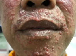 HIV rash