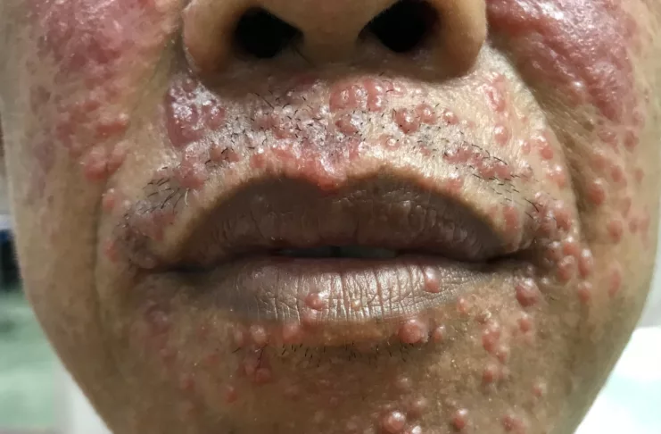 HIV rash