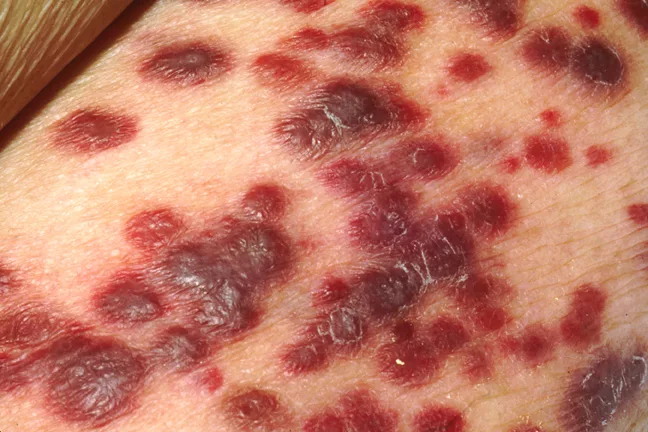 Kaposi Sarcoma Lesions on Skin