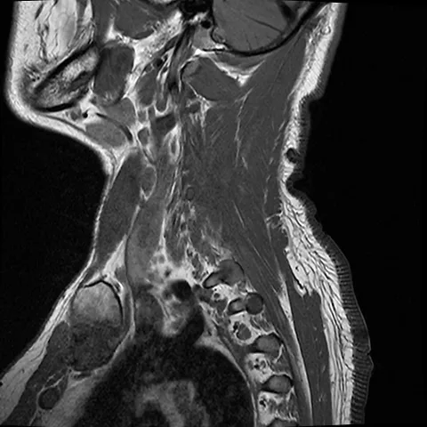 Scan showing the Cervical myelopathy from C4 t C5 with disc herniation at multiple sites