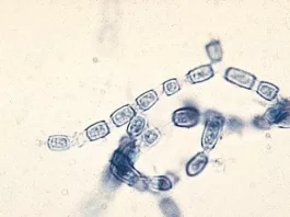 coccidioidomycosis