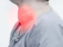 Multinodular Goiter causing lump in neck