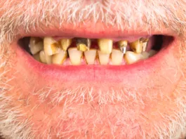 Scurvy causing teeth decay