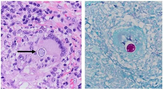 Coccidioidomycosis