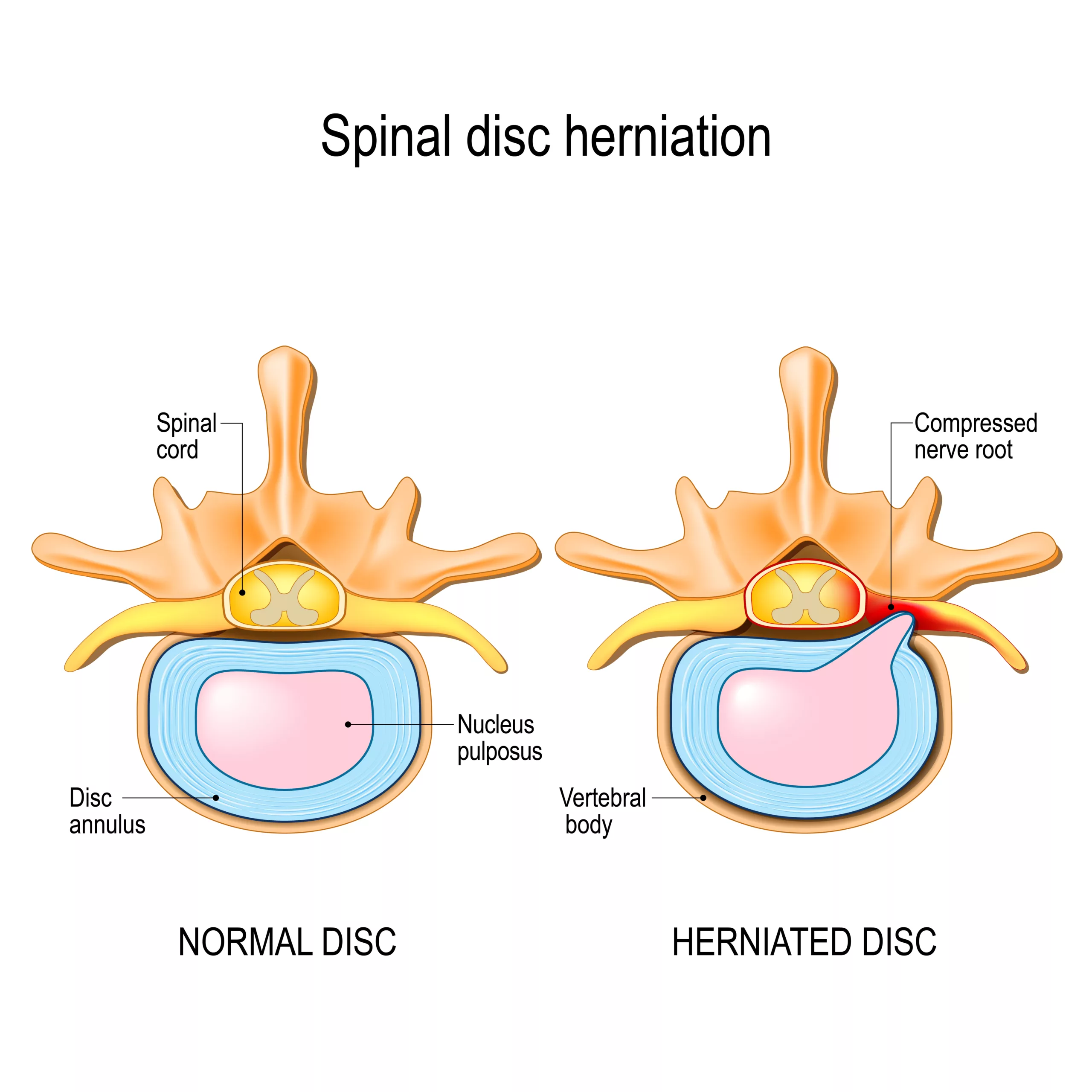 Image showing spinal disc herniation