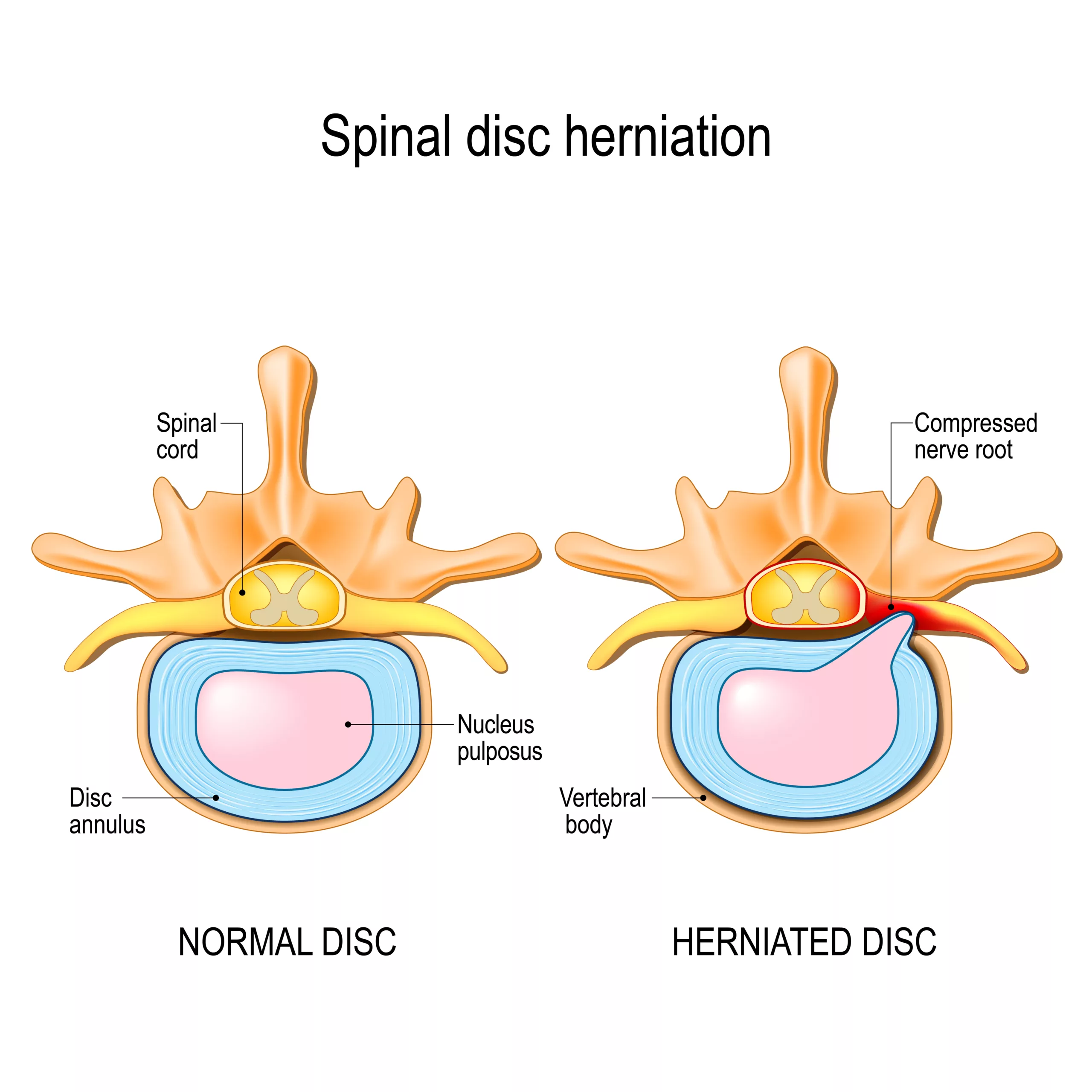Disc expanding beyond the capsule and compressing the nearby spinal nerve root