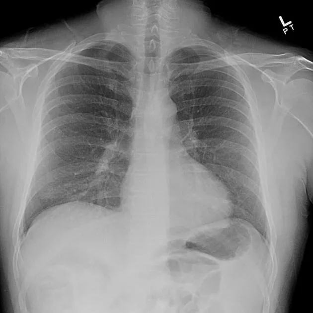 Chest X-Ray of a patient with Hypersensitivity Pneumonitis