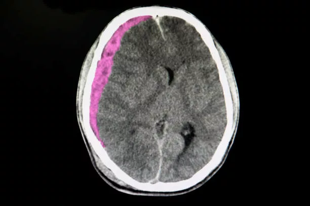 Image shows the CT scan of the brain of a patient with acute subdural hematoma. Intracerebral hemorrhage.