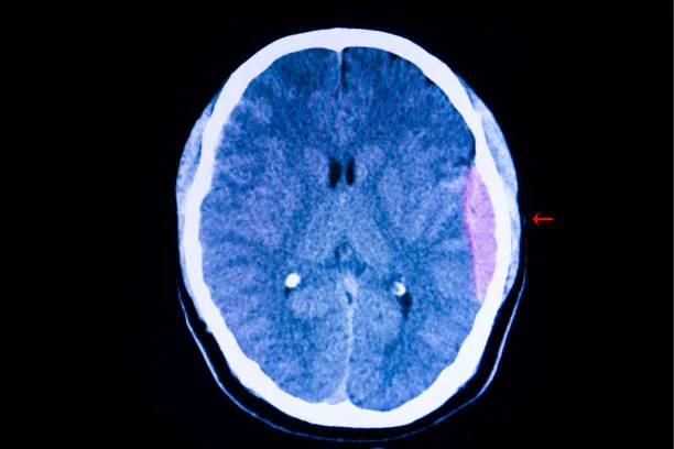 CT scan of the brain of a traffic accident patient showing large epidural hemorrhage on his left cerebral hemisphere with some degree of brain edema