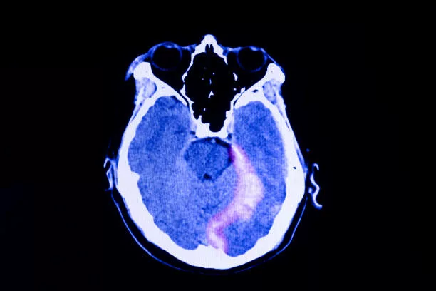 CT scan of the brain of a trumatic brain injury patient showing intracerebral hemorrhage with some degree of brain edema