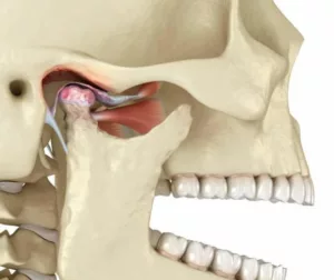 image of dysfunctional Temporomandibular joint