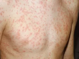 rash commonly associated with Congenital Rubella Syndrome