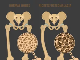 Image of the bones with Osteomalacia