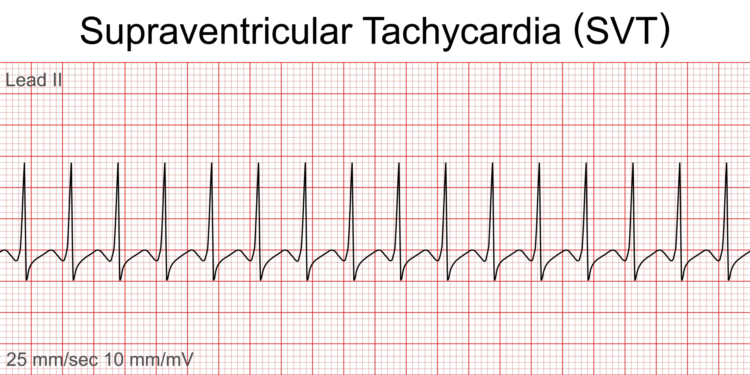 Supraventricular Tachycardia: Causes & Management