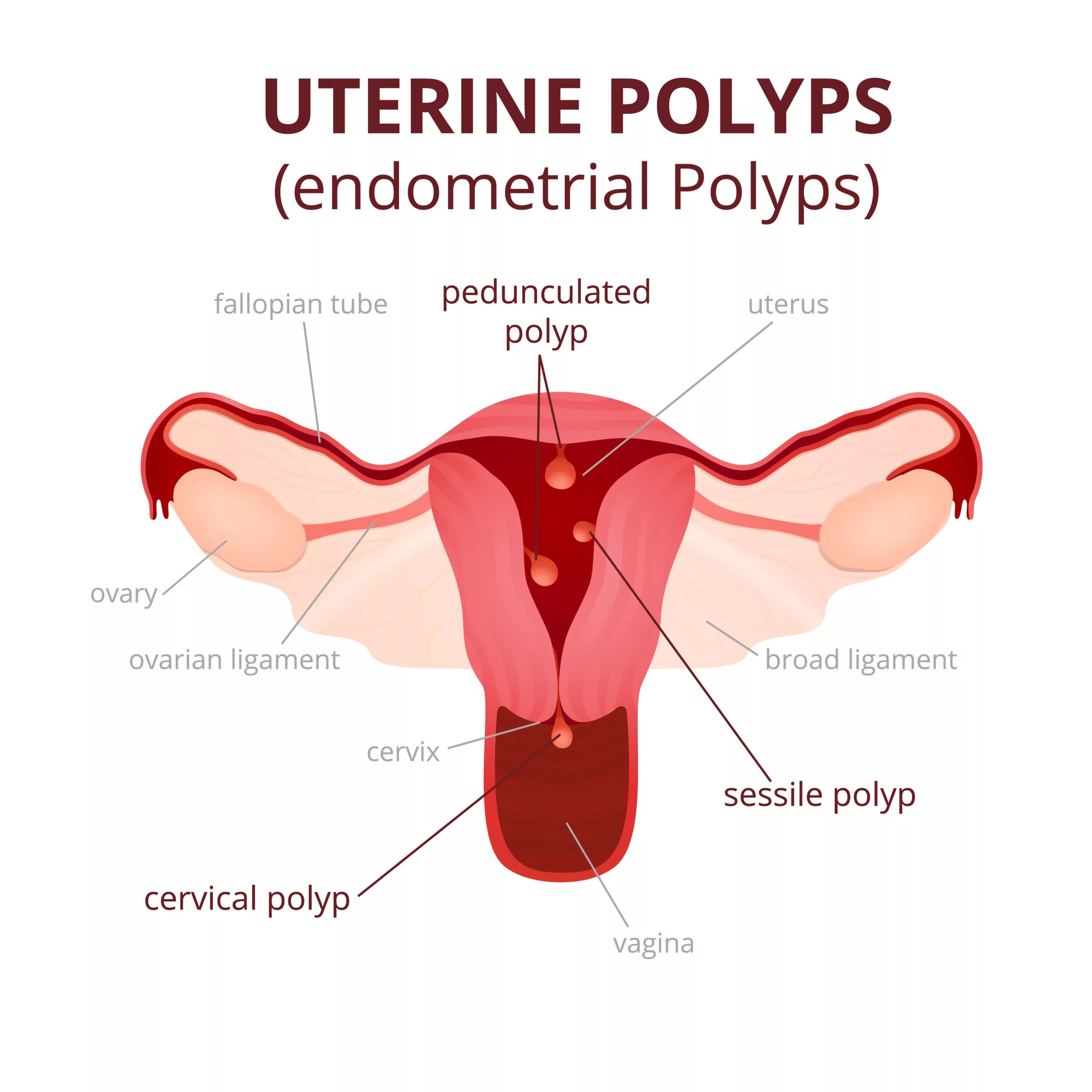 Image shows Polyp Types: Uterine cross-sectional view