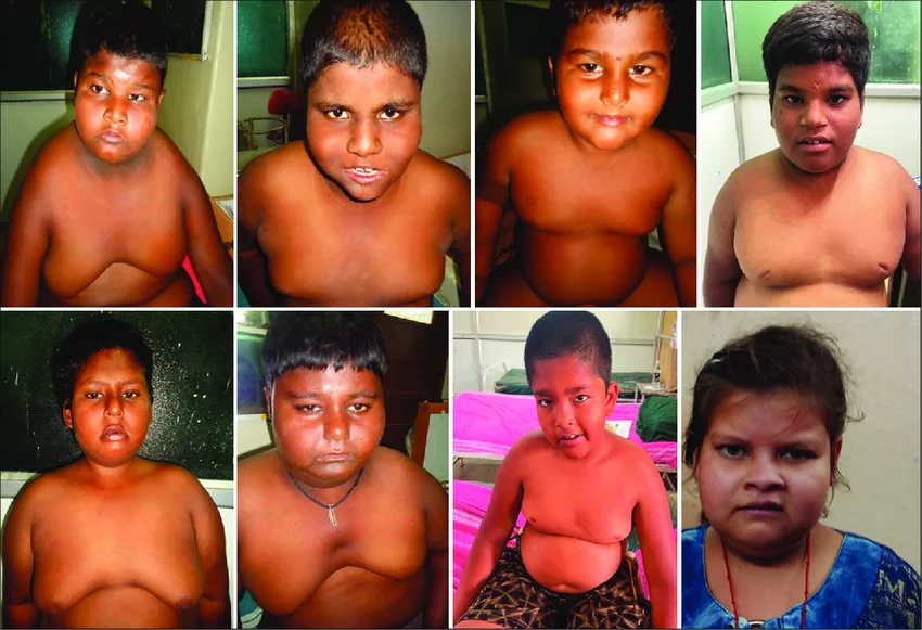 The image shows children with Prader-Willi Syndrome