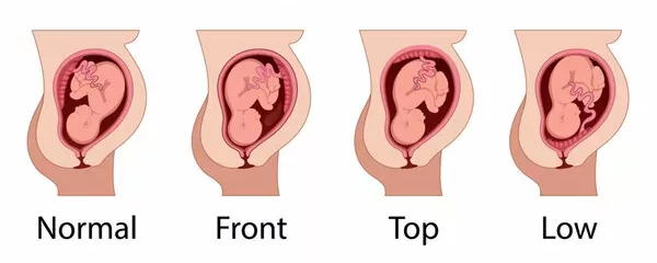 Image showing different positions where placenta could be attached