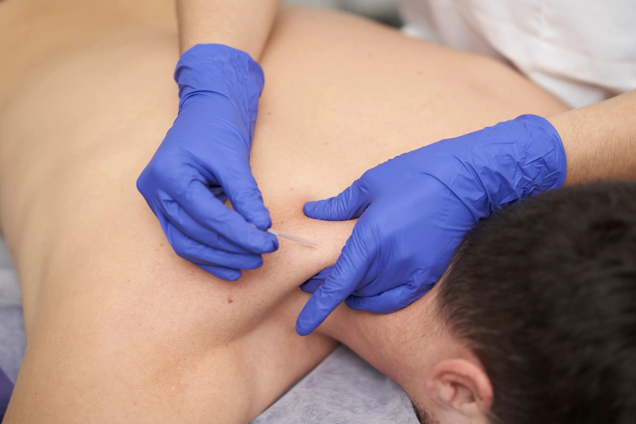 Dry Needling in muscle to relieve pain