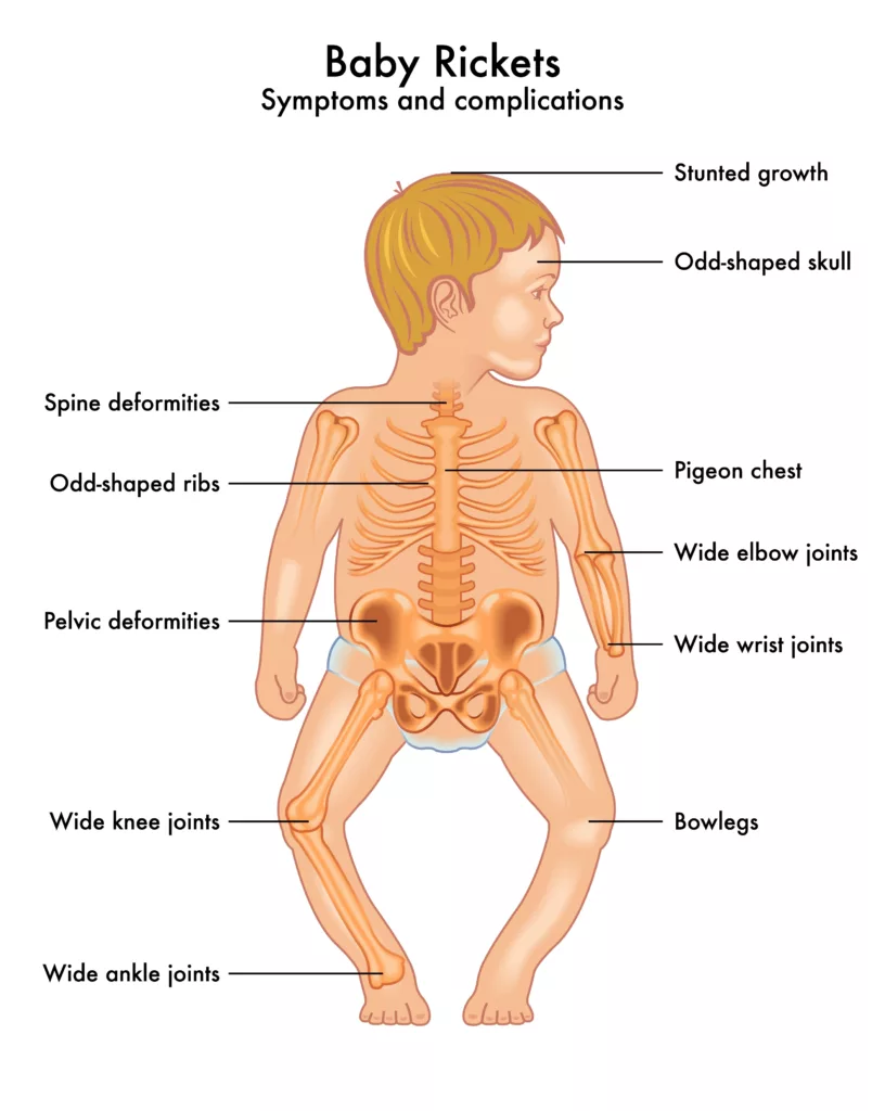 Picture illustrates signs of rickets in an infant