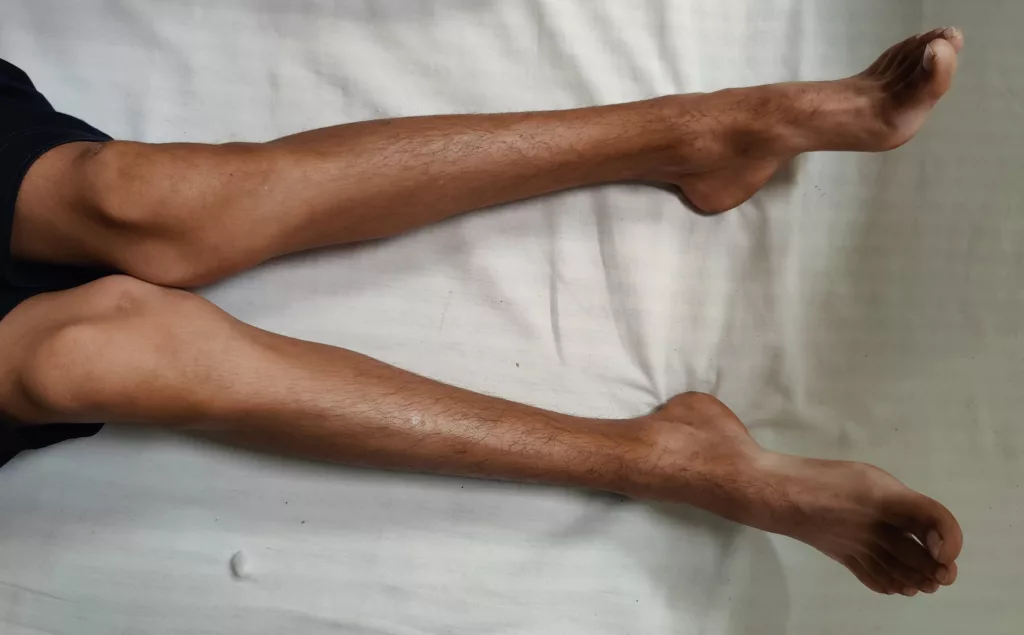 Leg Deformity in a patient with rickets