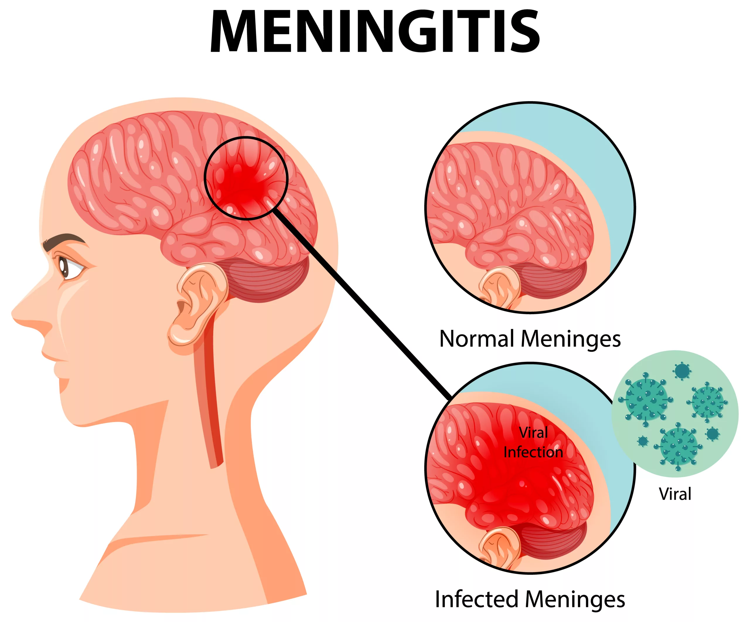  illustration of Meningitis in human brain