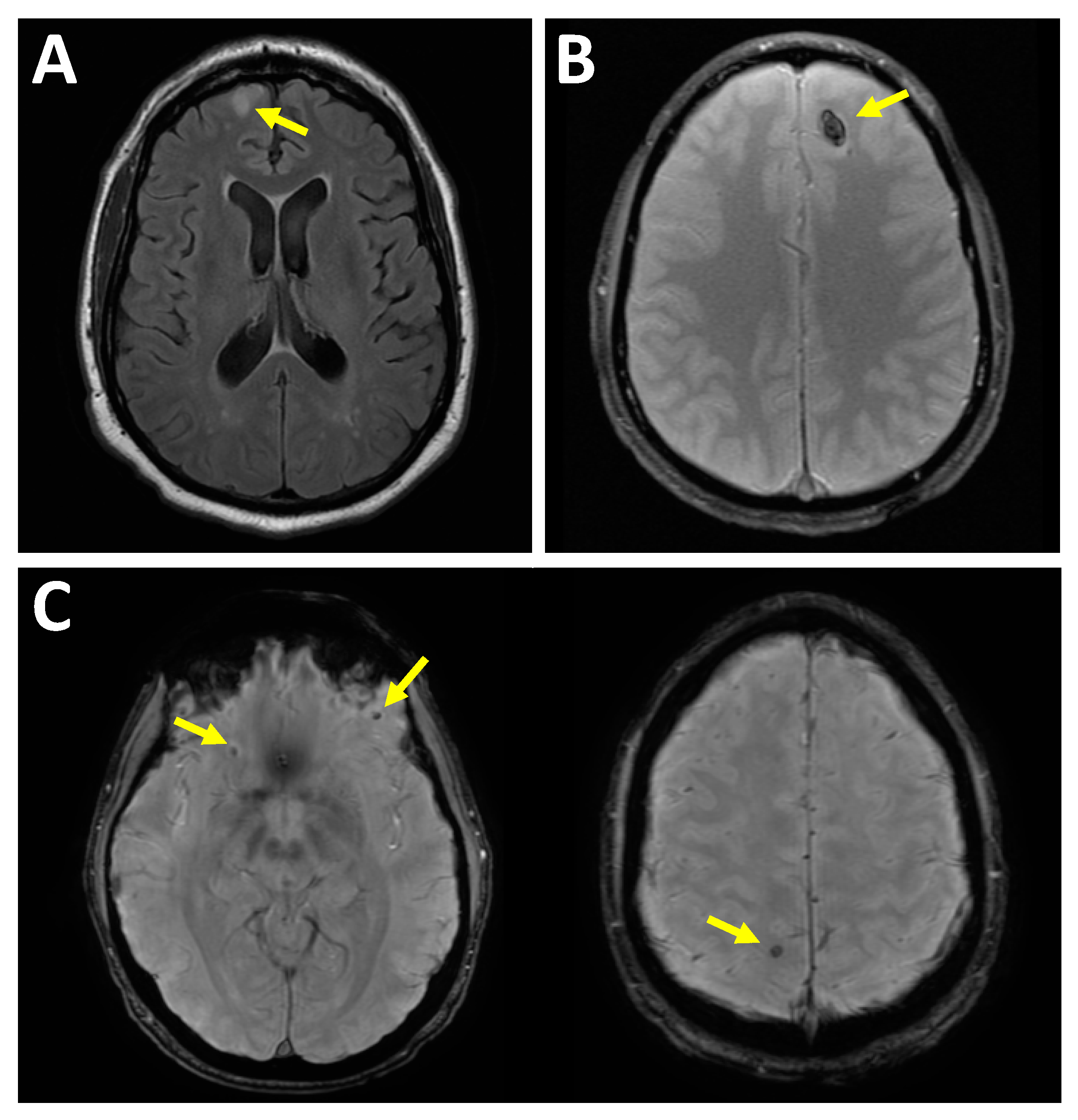 MRI of Brain Contusion