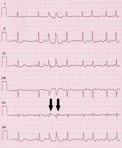 EKG of Paroxysmal Atrial Fibrillation