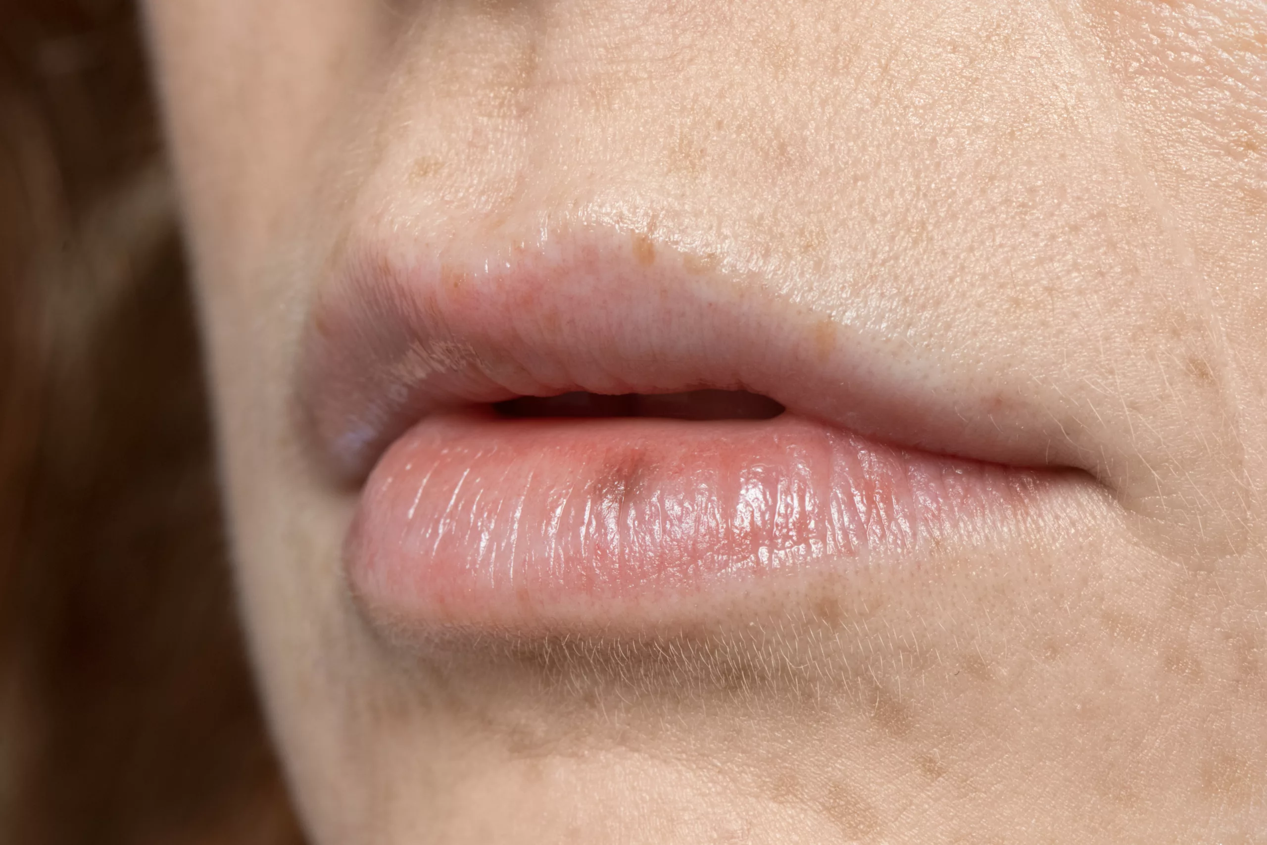 Sore Lip, which can be an early sign of lip cancer
