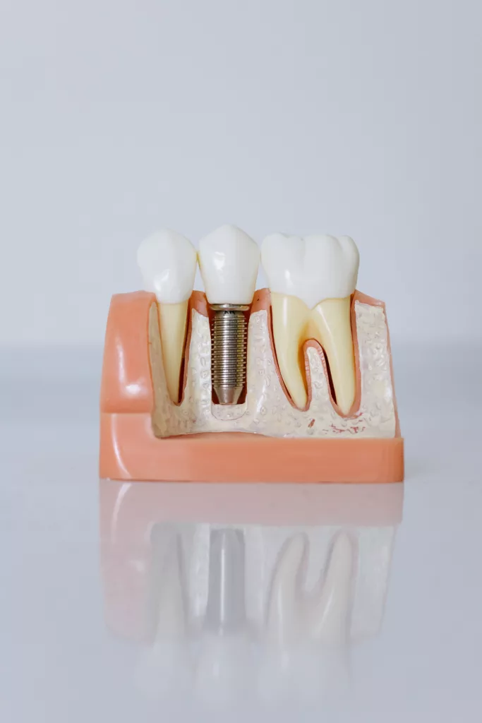 Image of different tooth Implant Technique