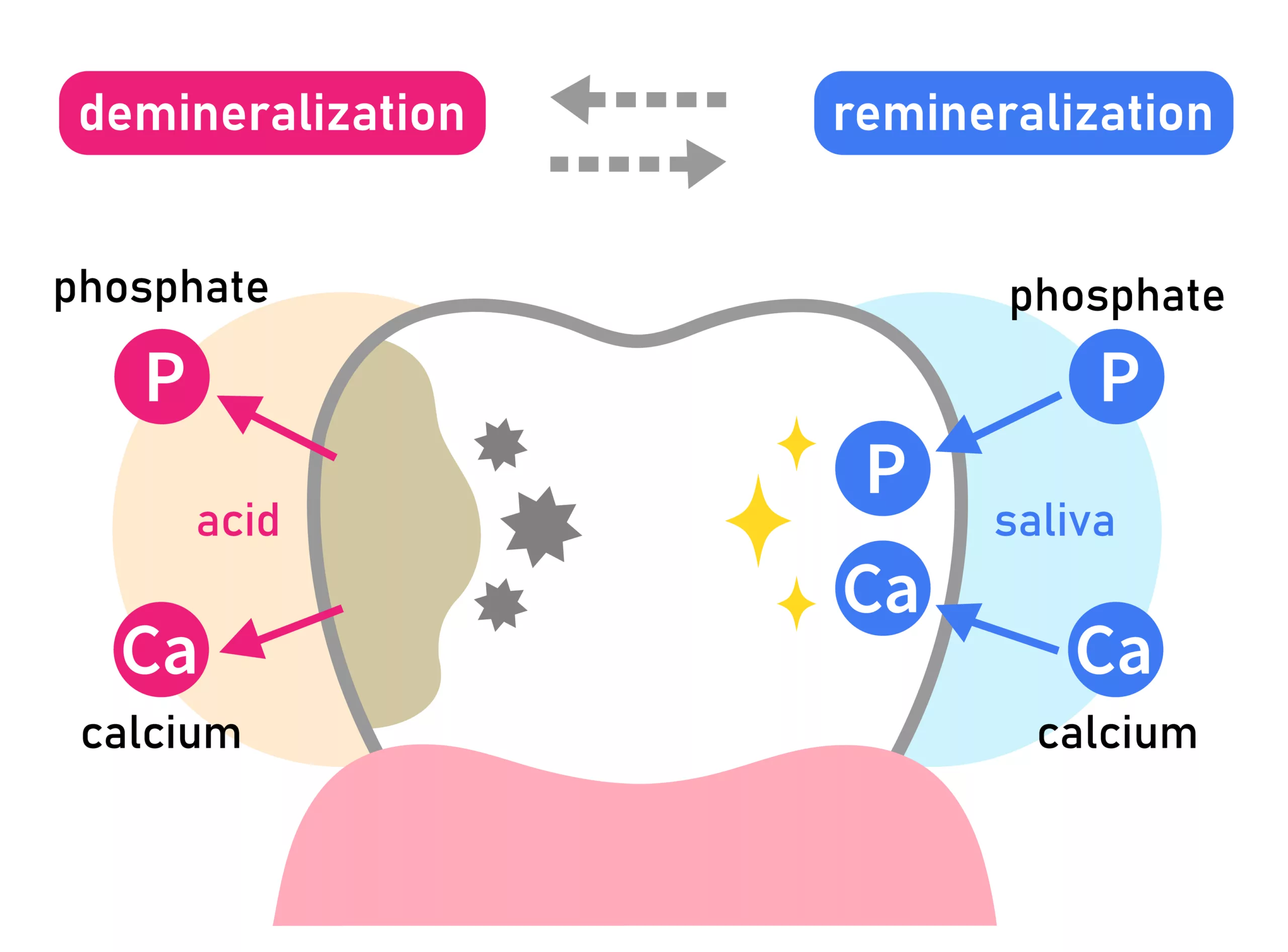 Illustration of Enamel Erosion