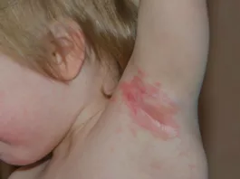 Image of a child suffering from Cutaneous Candidiasis