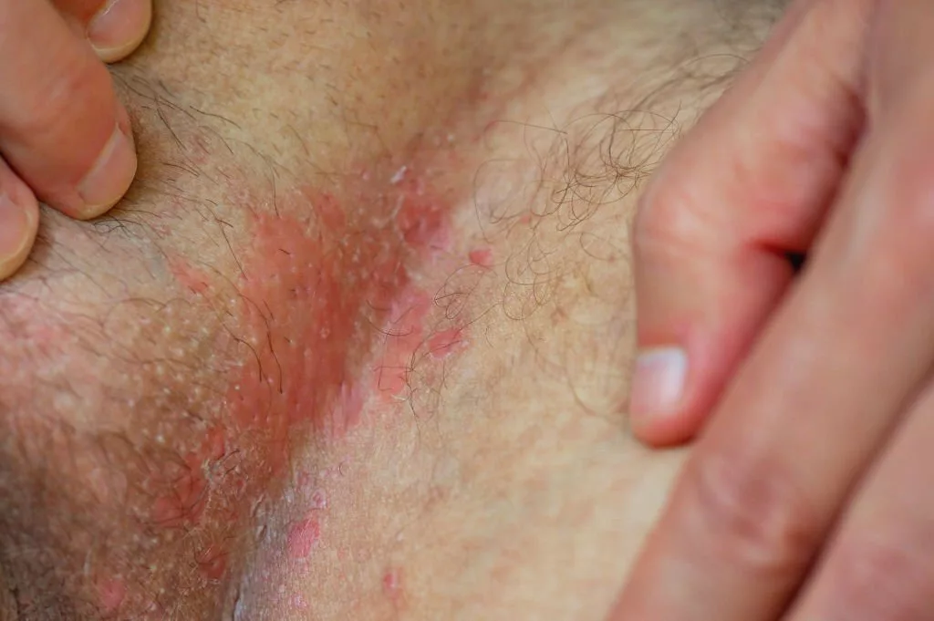 Image of an irritated part of the skin from fungal infection