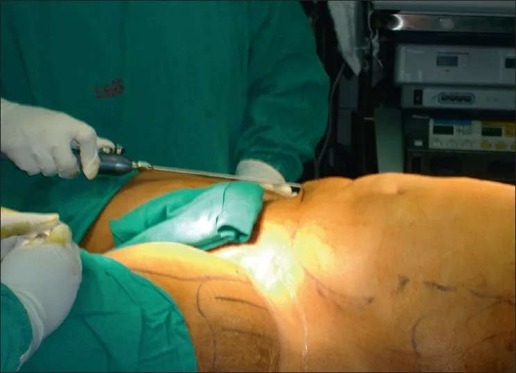 Liposuction of abdomen and thighs 